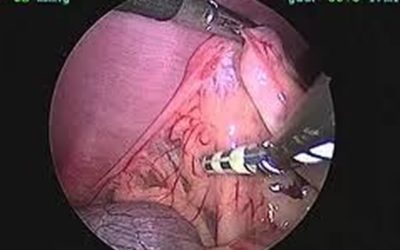 Laparoscopic Ovariectomy: A Less Painful Alternative