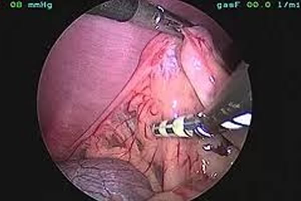 ovariectomy