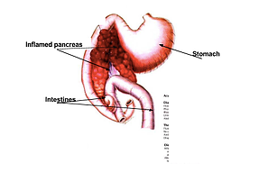 Pancreatitis