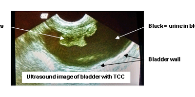 Transitional Cell Carcinoma (TCC)