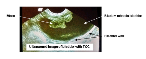 Transitional Cell Carcinoma (TCC)